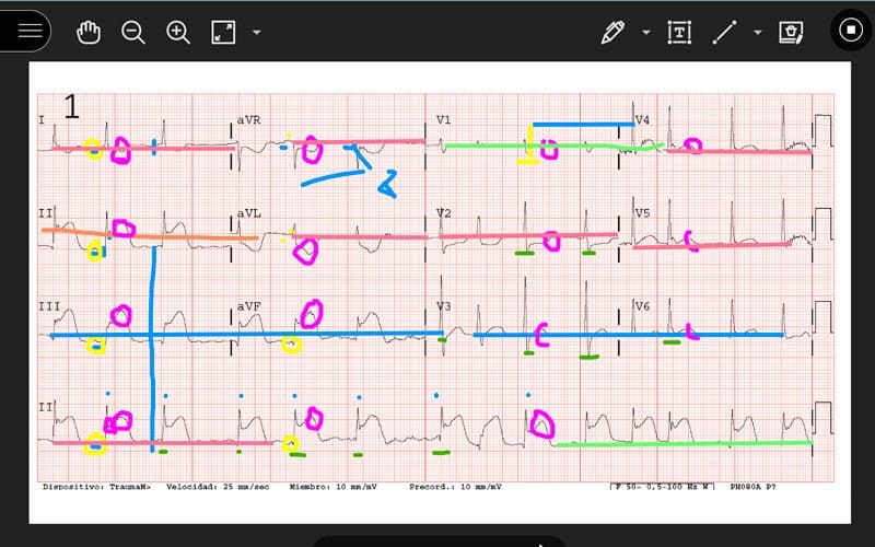 electrocardiografía