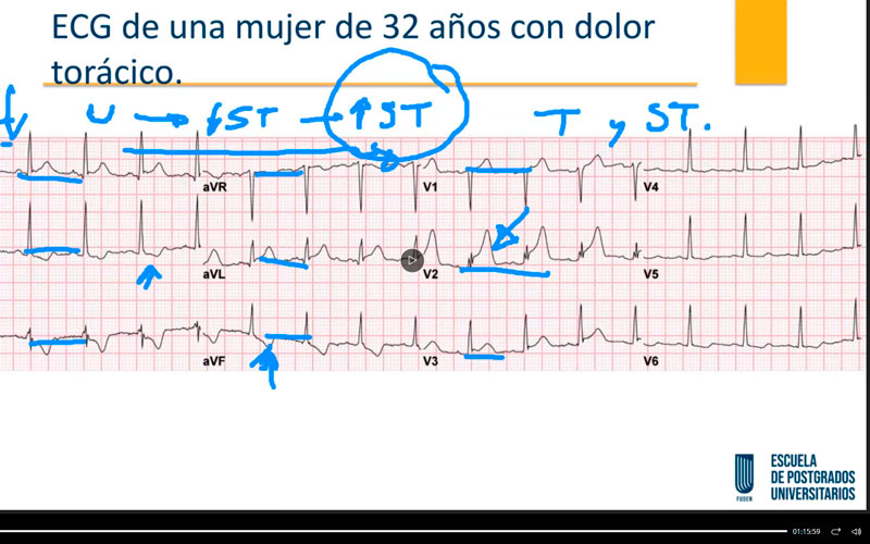 Taller de electrocardiografía práctica en el Experto en urgencias, emergencias y atención de enfermería a pacientes críticos