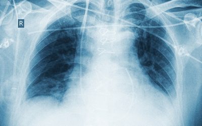 Semana de la Movilidad: las enfermedades respiratorias, tercera causa de muerte en el mundo